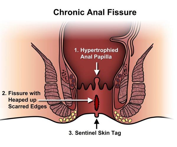 Fissure Treatment
